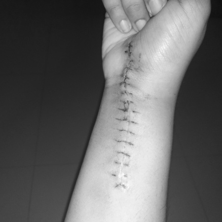 scar by avani lalka. we fall, get bruise, carry scar